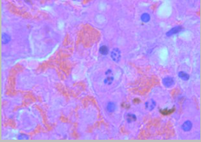 <p>What nuclear change is seen in this necrotic image?</p>
