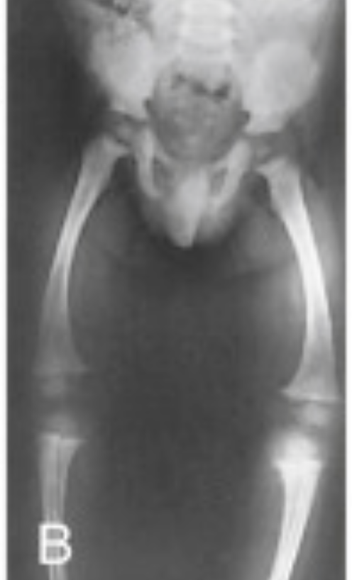 <p>What is this X-ray showing? What disease is it associated with?</p>