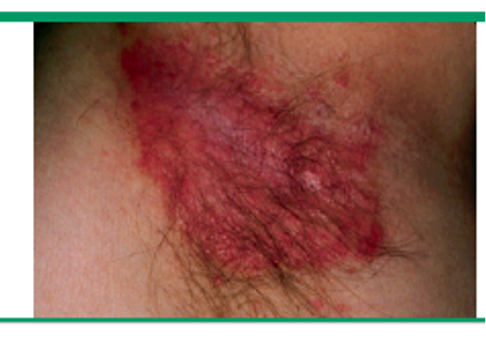 <p>what manifestation of psoriasis?</p><ul><li><p>well demarcated, smooth, shiny plaque w/ absent or minimal scale</p></li><li><p>often misdiagnosed as fungal or bacterial infx</p></li><li><p>intertriginous areas, inguinal, perianal, etc</p></li></ul><p></p>