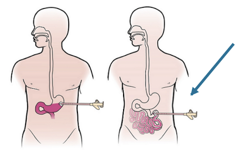 <ul><li><p>Tube directly placed in the jejunum (small intestine)</p></li><li><p>Performed in the OR</p></li><li><p>Can be advanced from a G-tube to a J-tube if feeds not tolerated</p></li><li><p>Used frequently in those who reflux tube feeds</p></li></ul><p></p>