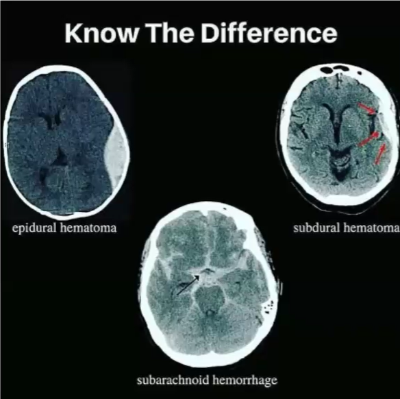 <p>active bleeding in brain<br><br>subarachnoid means below the arachnoid layer. we can recognize it by the central pocket being lit up.</p>