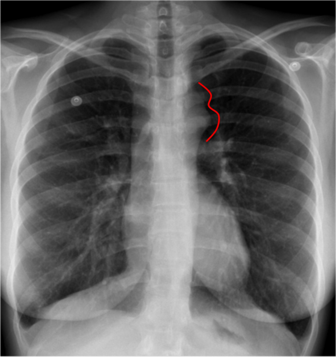 <p>rib notching</p><p>note:</p><p>"3 sign" on barium swallow</p><p>angiogram gold standard</p><p>Tx balloon angioplasty, PGE1</p>