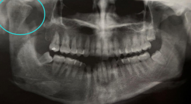 <p>excessive growth of condyle due to NEOPLASM/ ENDOCRINE distubances</p>