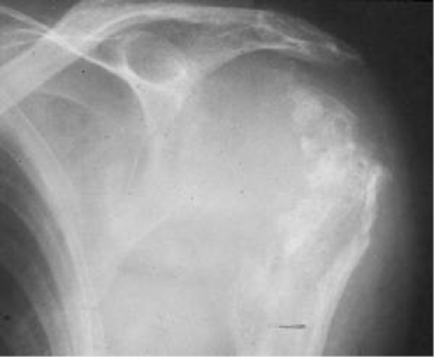 <p>Malignant degeneration of benign process</p><p>- Paget disease</p><p>- Fibrous dysplasia</p><p>- Osteochondroma</p>