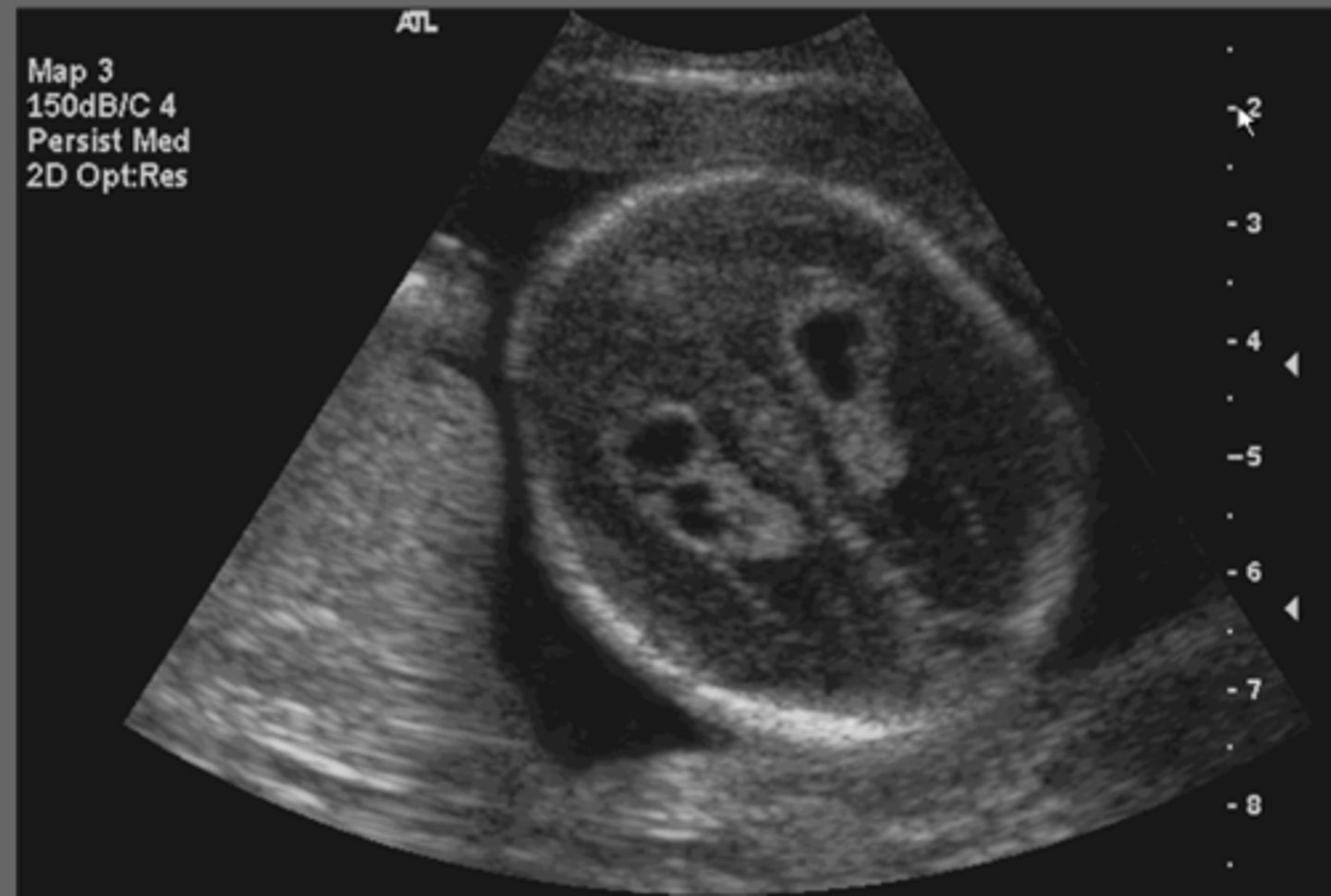 <p>Must be at least 2mm</p><p>Associated with Trisomy 18</p>