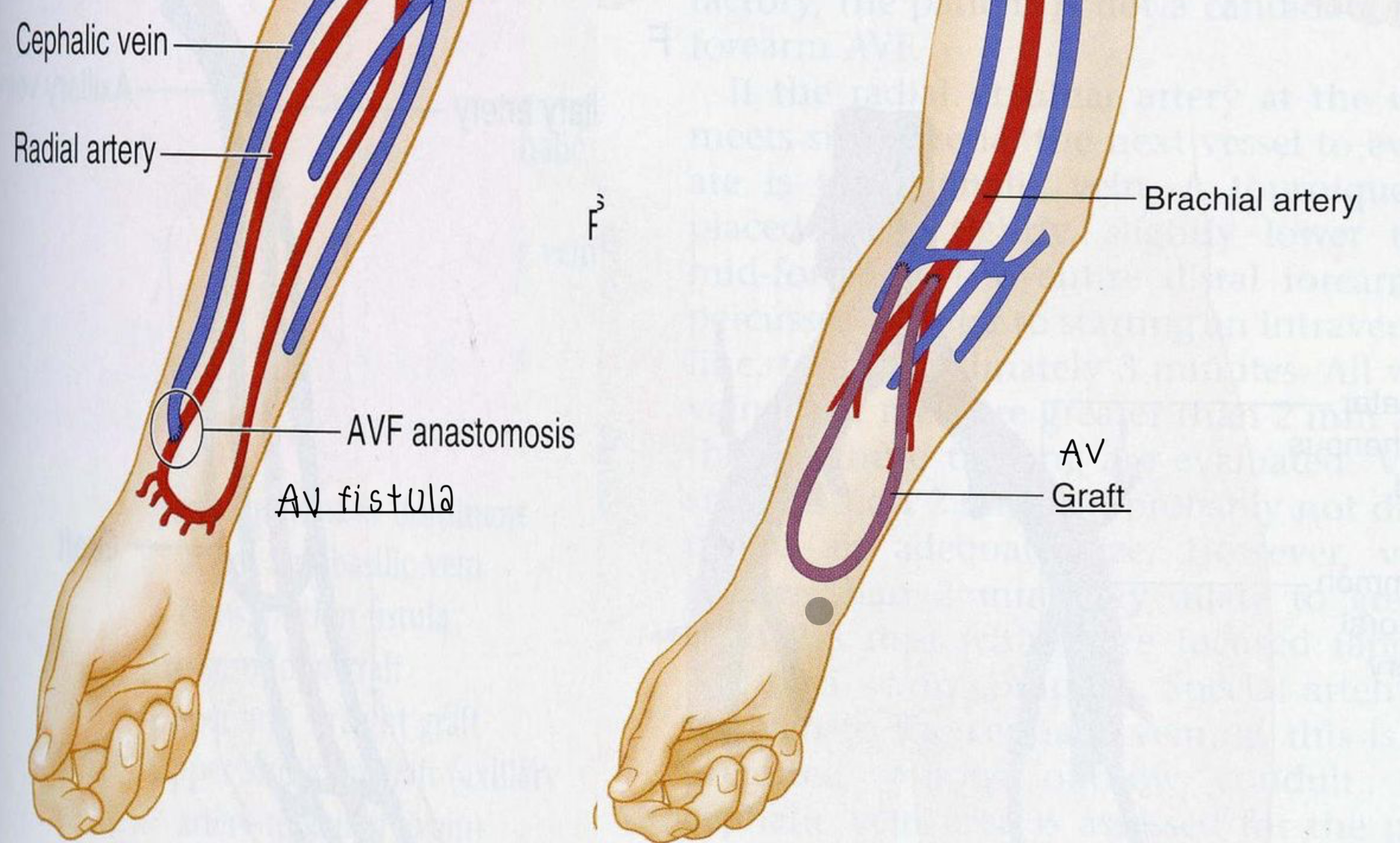 <ul><li><p><mark data-color="unset" style="background-color: unset; color: inherit;">AV fistula connects an artery directly to a vein — 1st choice bc less invasive</mark></p></li><li><p><mark data-color="unset" style="background-color: unset; color: inherit;">AV graft connects an artery to a vein using a synthetic tube — external </mark></p></li></ul><p></p>