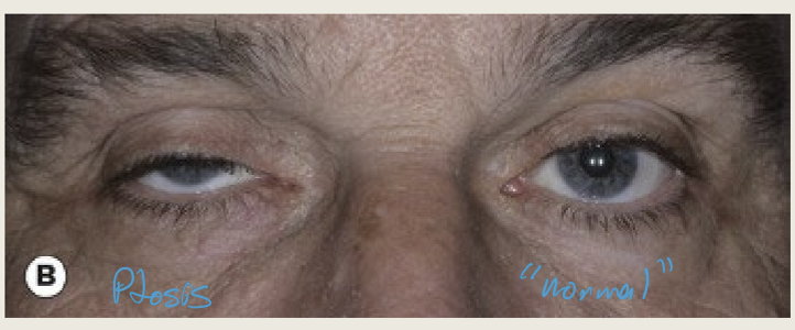 <ul><li><p>Myastenia gravis (ptosis that worsens with fatigue)</p></li><li><p>Myotonic dystrophy</p></li></ul><p></p>