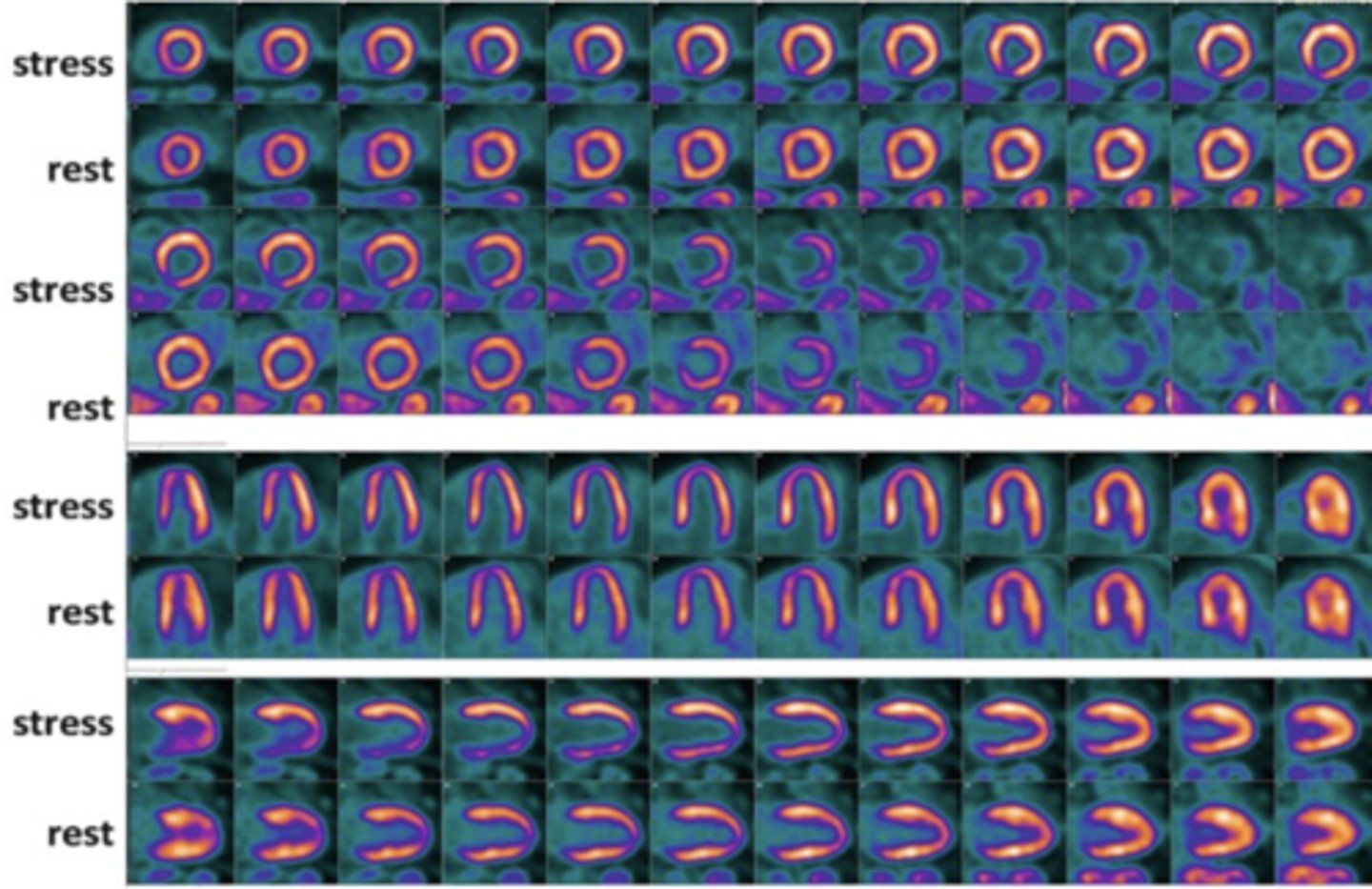 <p>a narrowed right coronary artery</p>