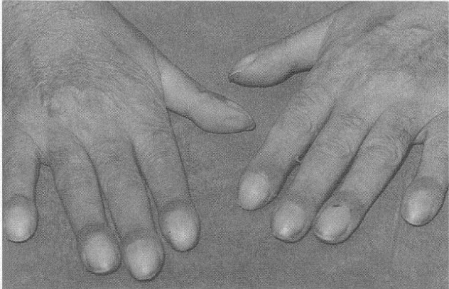 <ol><li><p>clubbing of distal fingers</p></li><li><p><strong>arthritic conditions</strong> in <u>bones </u>&amp; <u>joints </u>of <em>wrists </em>&amp; <em>ankles</em></p></li></ol><p></p>