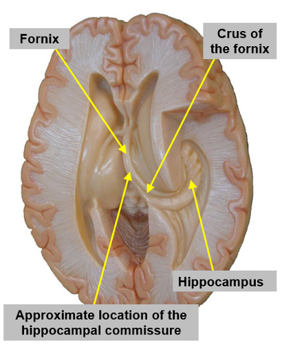 <p>lies in the floor of the lateral ventricle, near the <strong>parahippocampal gyrus </strong>on the inferior surface of the temporal lobe of the brain</p>