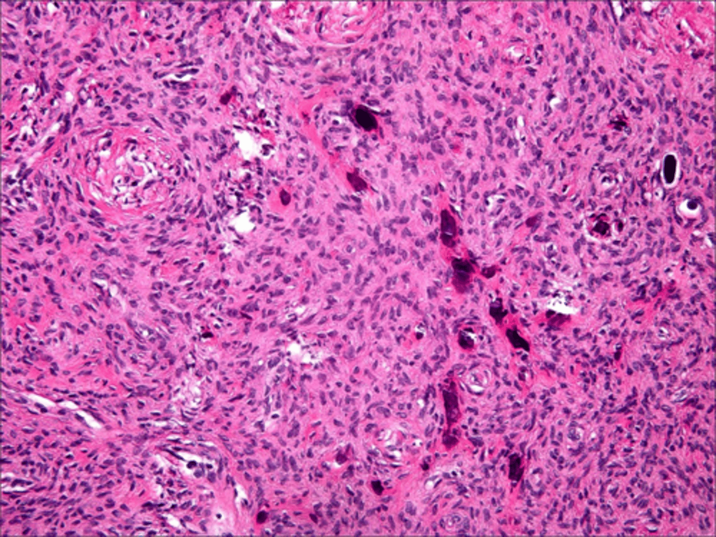 <p>fibrous proliferation with formation of mineralized (osseous) product is associated with what pathology?</p>