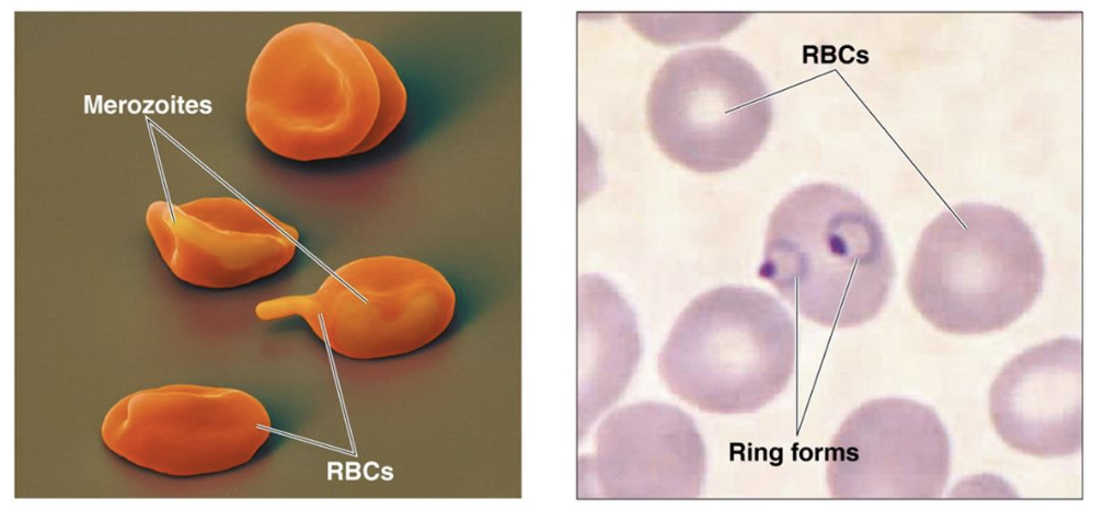 <ul><li><p>cardiovascular/lymphatic protozoal disease</p></li><li><p>cause: <em>Plasmodium </em>protozoans</p><ul><li><p>different stages:</p><ul><li><p>sporozoite: carried by mosquito</p></li><li><p>merozoite: transforms in liver; ruptures RBCs</p></li><li><p>trophozoite: multiplies after RBC invasion → more merozoites</p></li></ul></li></ul></li><li><p>transmission: infected <em>Anopheles</em> mosquito bite</p></li><li><p>symptoms: fevers and chills because of infected RBC ruptures</p></li></ul><p></p>