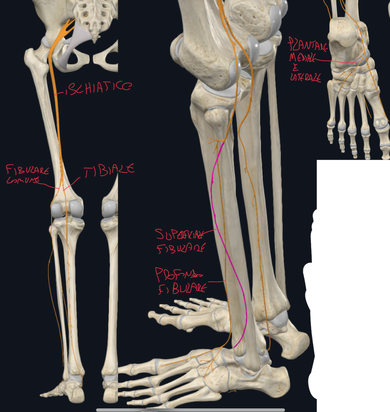 <p>E’ il più voluminoso dell’organismo</p><p>Decorso:</p><ul><li><p>Esce dalla pelvi dal grande forame ischiatico, sotto il piriforme</p></li><li><p>Passa sotto il grande gluteo e scende nella coscia lungo la linea mediana tra grande trocantere e tuberosità ischiatica</p></li><li><p>A livello della fossa poplitea divide nei suoi rami terminali:</p><ul><li><p>Nervo Tibiale e Fibulare comune</p></li></ul></li></ul><p>NERVO TIBIALE:</p><ul><li><p>Dalla fossa poplitea scende nel compartimento posteriore della coscia innervandolo (ad eccetto del capo breve bicipite femorale innervato dal fibulare)</p></li><li><p>Passa dietro il malleolo mediale e attraversa il tunnel tarsale dove nel piede divide in PLANTARE MEDIALE E LATERALE</p></li><li><p>Invia sia rami motori che sensitivi per la cute</p></li><li><p>Funzione → flessione plantare e inversione</p></li><li><p>E’ quindi per il compartimento posteriore della gamba</p></li></ul><p>NERVO FIBULARE COMUNE</p><ul><li><p>Dalla fossa poplitea si porta lateralmente dove avvolge il collo della fibula</p></li><li><p>Decorre superficialmente, infatti è il più frequentemente lesionato:</p><ul><li><p>Lesione causa piede cadente, perché manca la flessione dorsale controllata</p></li></ul></li><li><p>Divide in Nervo Fibulare superficiale e profondo:</p><ul><li><p>Nervo Fibulare Superficiale per i muscoli fibulari lungo e breve e cute laterale gamba, caviglia, piede e dita<br>Funzione → eversione piede<br>E’ quindi per il compartimento laterale della gamba.</p></li><li><p>Nervo Fibulare Profondo per i muscoli del compartimento anteriore della gamba e muscoli dorsali del piede (estensore breve dita e alluce).<br>Anche cute tra alluce e secondo dito.<br>Funzione → flessione dorsale piede e inversione (anche eversione con il fibulare terzo).<br>E’ quindi per il compartimento anteriore della gamba.</p></li></ul></li></ul><p></p><p></p>
