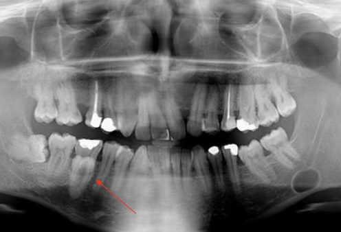 <p>What are some radiographic and clinical features of Stafne Bone Cyst?</p>