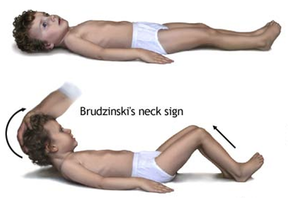 <p>Checking for neck stiffness may include tilting the head is tilted forward and the knees will bend in result (AKA positive) indicative of:</p><p>-Severe meningeal inflammation</p><p>-Evidence of microbiological CSF infection</p>