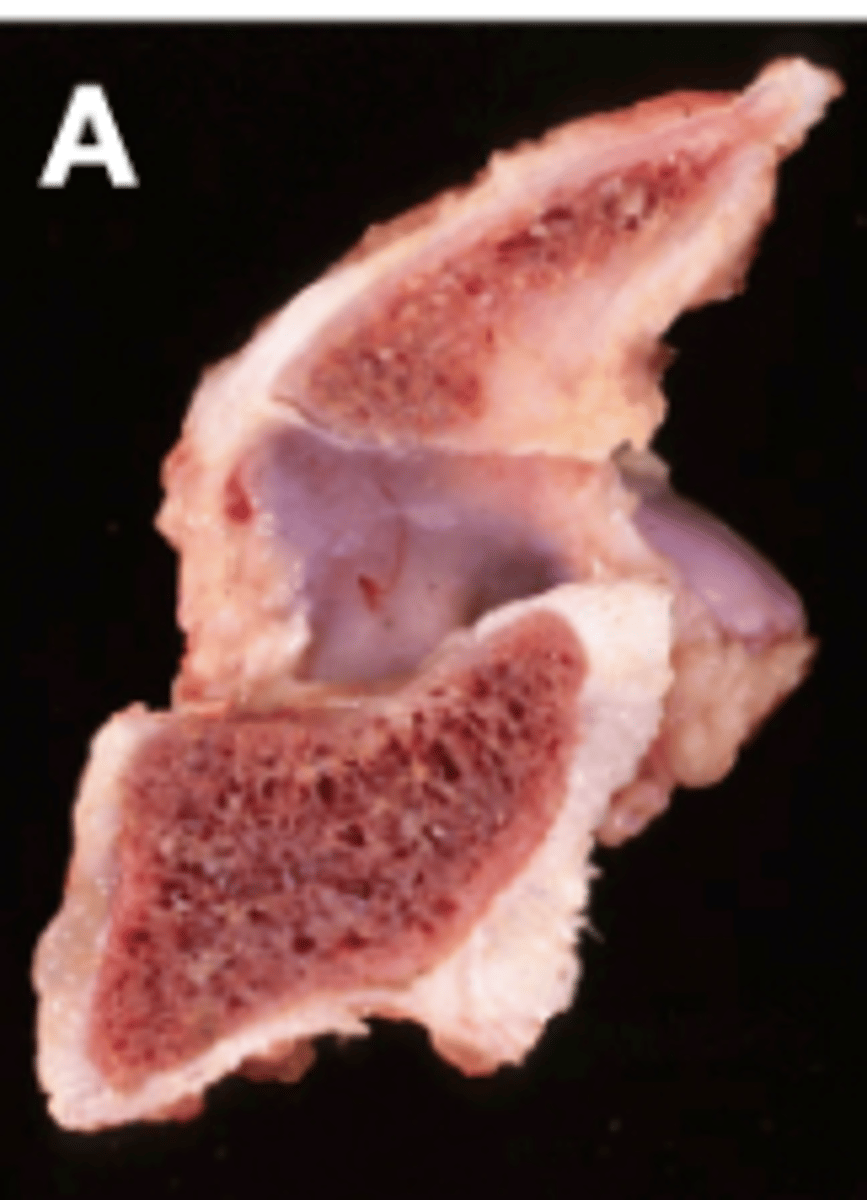 <p>- Hemivertebrae (A) and block vertebrae</p>
