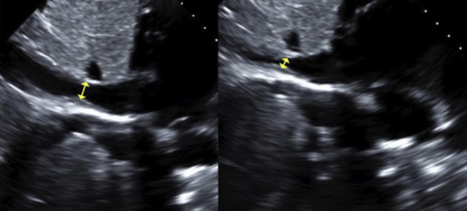 <p>Evaluate the IVC to achieve the ____________?</p>