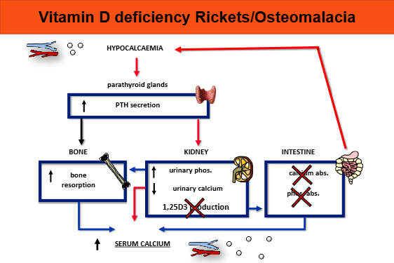 <p>Rickets when affects growing skeleton- osteomalacia when affects adult skeleton</p><p>bones unduly soft, loss of calcium from bones </p><p>rickets: osteoid at growth plate is weak —> bow legs, growth plate expands to compensate (swollen koints)</p><ul><li><p>as it grows longer, without calcification, compression from body weight = bendy bones </p></li></ul><p>osteomalacia —> bone pain and pseudofractures </p>