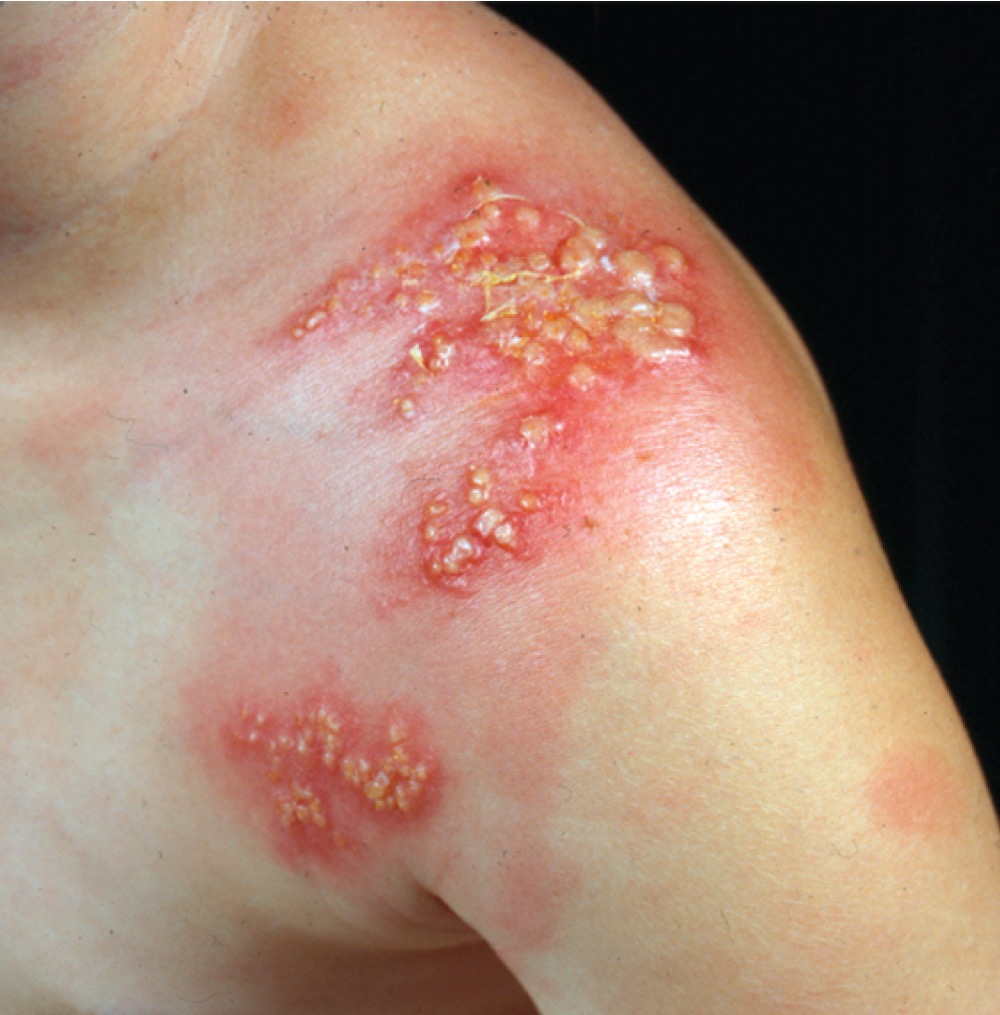 What is this? ATA

A. Herpes zoster

 B. Shingles 

C. An infection due to varicella virus 

D. A severe sunburn 

E. Poison ivy
