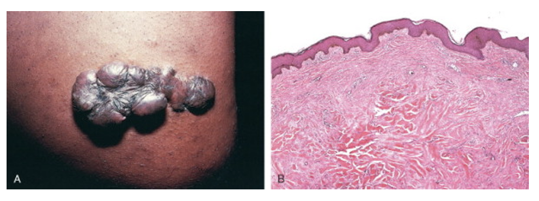 <p>Pathological aspects of wound healing:</p><p>What does this example depict?</p>