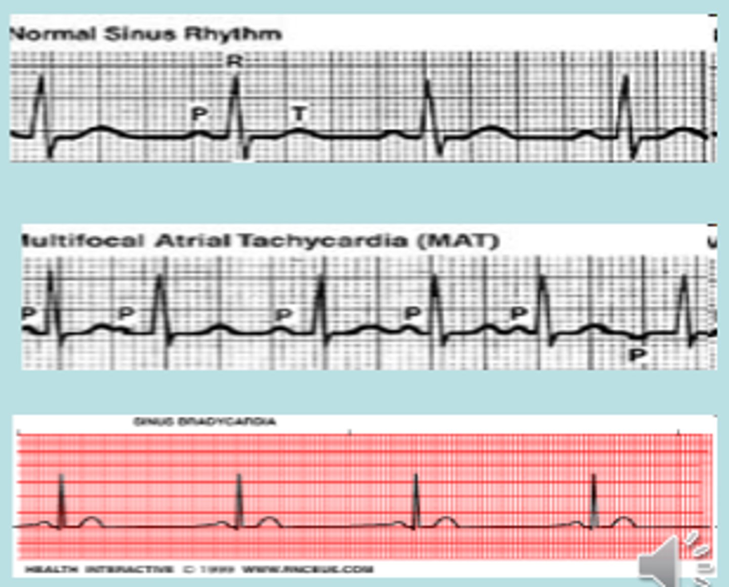 <p>If sinus frequency rises above 100/min (exercise, psychic excitation, fever, rise of 10 beats/min</p>