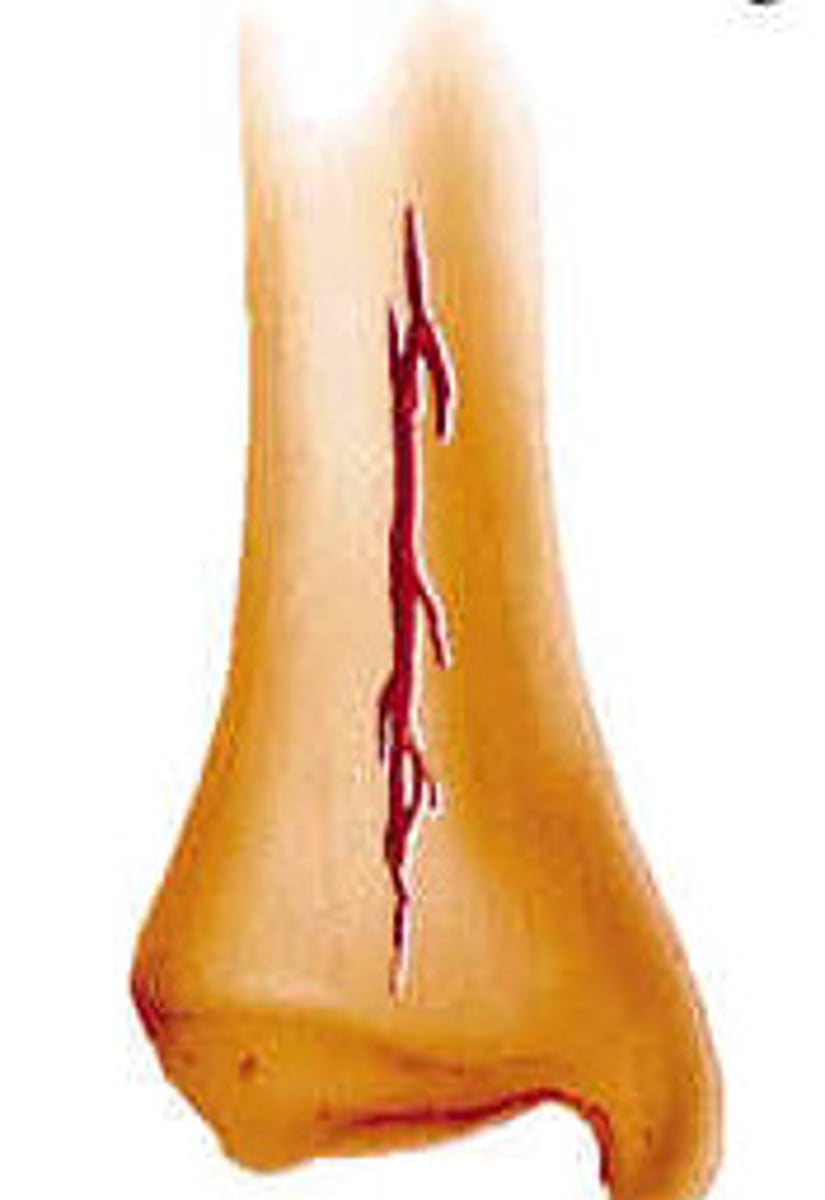 <p>Fissured - incomplete longitudinal break</p>