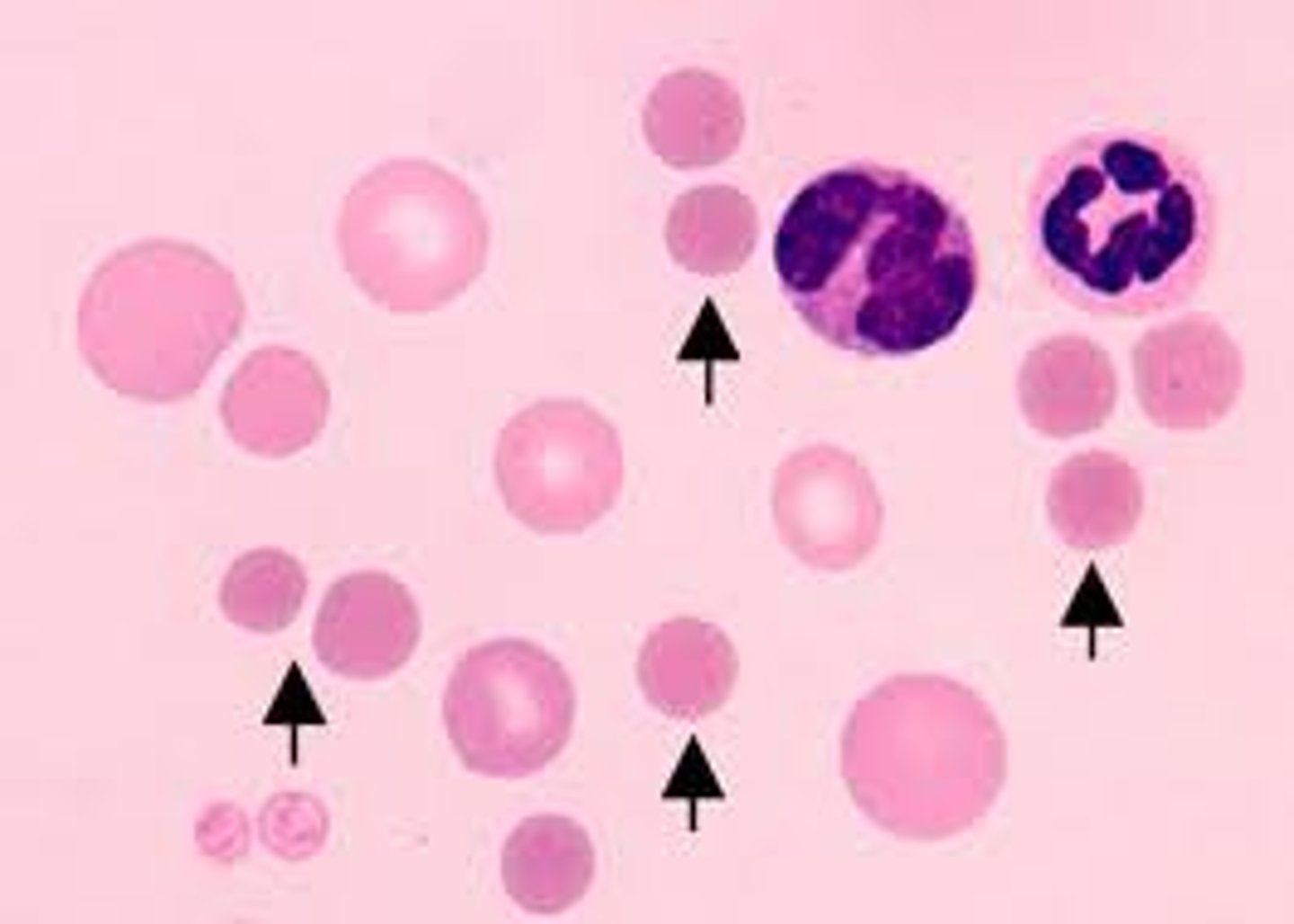 <p>Darkly staining RBC with reduced or no central pallor. Not easily identified in species other than dogs. These cells suggest the immune mediated destruction of RBC's which results in hemolytic anemia.</p>