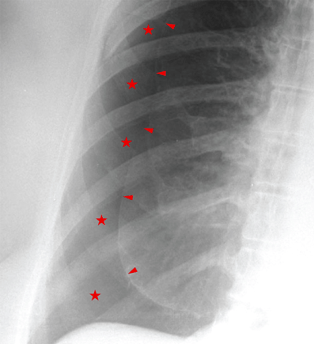 <p>CXR</p>