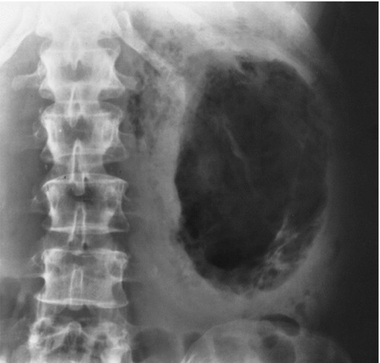 <p>- What are the forming bacteria that cause an infection in diabetic patients?</p><p>- What can happen to the entire kidney?</p><p>- What appears on the kidney radiographically?</p><p>- What is the preferred method of diagnosis for this pathology?</p>