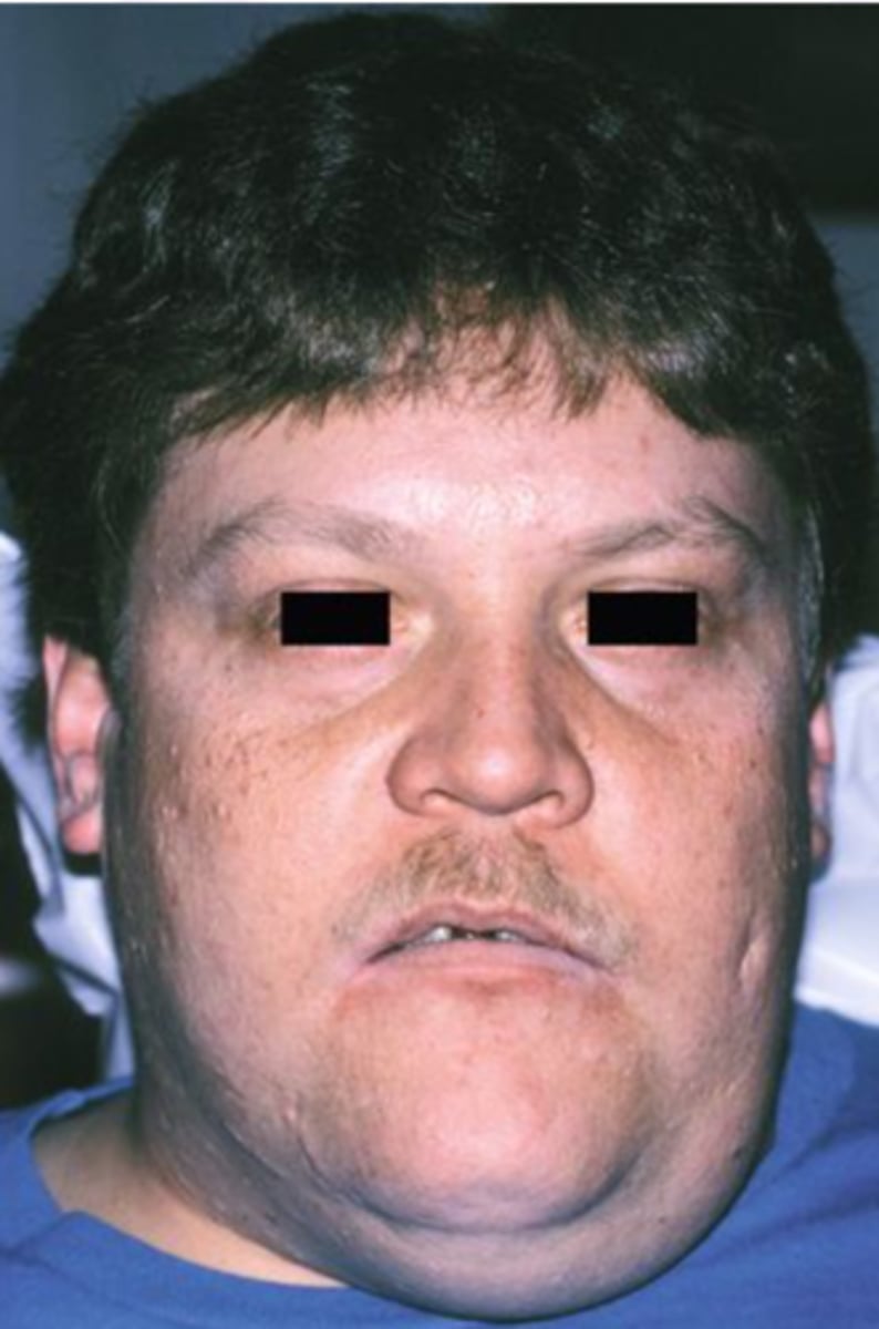 <p>Resembles frogs</p><p>underbelly, Less common type of mucocele</p>
