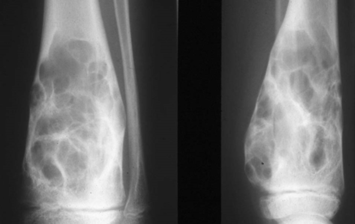 <p>Vignette # 17</p><p>Sex: Male</p><p>Age: 13</p><p>Chief Complaint: Young athlete presents with ankle pain and swelling one day after an injury from basketball. Pain feels worse with movement and feels better with rest. Pain is felt in all ranges of motion.</p><p>Objective Findings: Anterior Drawer’s + Diagnostic imaging: X-ray</p><p>2. What are the differential diagnoses? (Choose 3)</p><p>a. Sprain/strain</p><p>b. Quasimalignant bone tumor</p><p>c. SBC (<20, fluid filled tumor, fallen fragment sign, no bone expansion)</p><p>d. Epiphyseal fracture</p><p>e. Ewing’s (10-25, diaphysis of long bones, onion skin, codman’s triangle,</p><p>saucerization)</p><p>f. ABC(<20, located on one side, expands bone)</p><p>g. Blood filled lesion</p><p>h. Fluid filled lesion (SBC/UBC)</p>