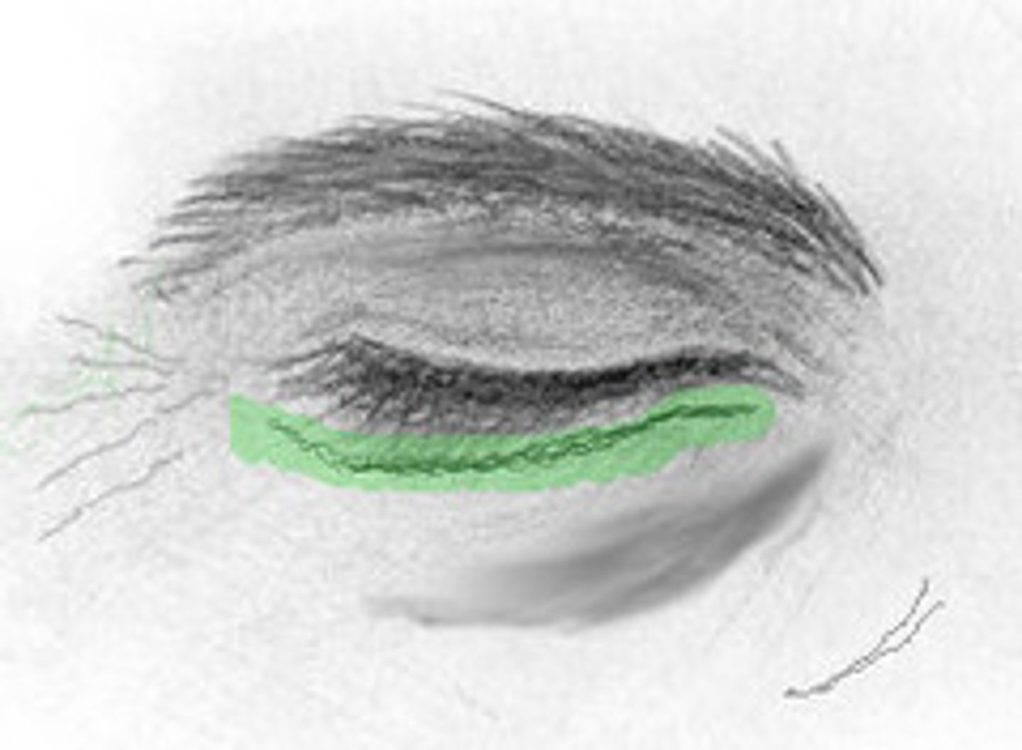 <p>appear in the inferior medial corner of your eyes; acquired</p>
