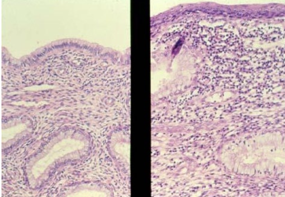 <p>Replacement of ciliated columnar epithelium by stratified squamous epithelium in response to chronic inflammation (eg. chronic pelvic inflammatory disease or smoking) is an example of ________</p>