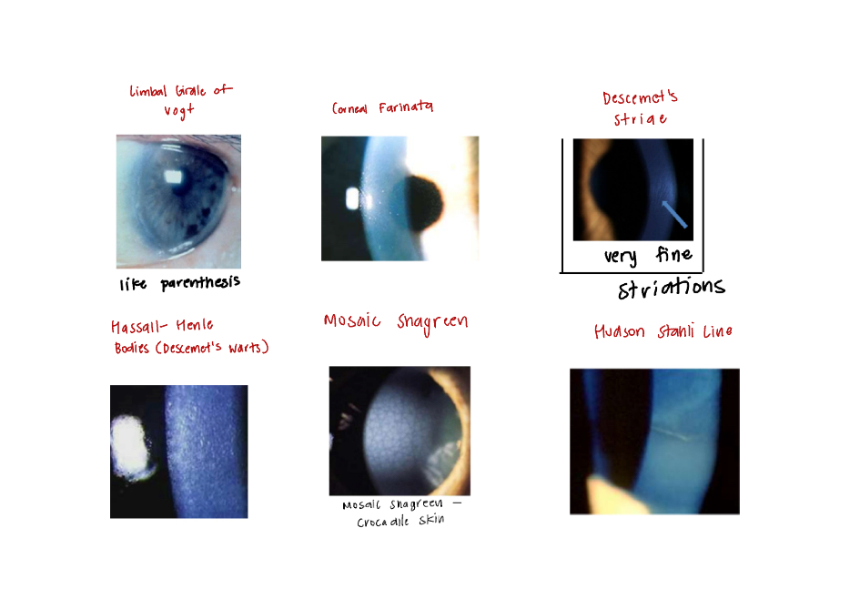 <ul><li><p>Generally asymptomatic and not visually significant</p></li><li><p><strong>Limbal Girdle of Vogt:</strong></p><ul><li><p>Below epithelium at Bowman’s level&nbsp;</p></li><li><p>Looks like parenthesis&nbsp;</p></li><li><p><em>4th year said you have this</em>&nbsp;</p></li></ul></li><li><p><strong>Corneal Farinata:&nbsp;</strong></p><ul><li><p>Flour dust deposits <u>deep in the corneal stroma&nbsp;</u></p></li><li><p>Almost exclusively at the central interpalpebrel limba region&nbsp;</p></li><li><p>Normal endothelial&nbsp;“mosaic” underneath&nbsp;</p></li></ul></li><li><p><strong>Descemet’s Striae:&nbsp;</strong></p><ul><li><p>DDX: Vogt’s striae (vertical), Hobbes striae (horizontal)</p></li></ul></li><li><p><span style="color: green;"><strong>Hassal-Henle Bodies (Descemet’s&nbsp;“Warts”):&nbsp;</strong></span></p><ul><li><p>Buildup of <span style="color: green;"><strong><span>hyaline </span></strong></span>material on the endothelium</p></li></ul></li><li><p><strong>Mosaic Shagreen (crocodile skin):&nbsp;</strong></p><ul><li><p>Anterior: b/w Basal Epithelium and Bowman’s</p></li><li><p>Posterior: b/w Stroma and Descemet’s&nbsp;</p></li></ul></li><li><p><span style="color: rgb(82, 74, 59);"><strong>Hudson Stahli Line:&nbsp;</strong></span></p><ul><li><p>Iron deposits on the lower 1/3 of the cornea</p></li></ul></li></ul><p></p>