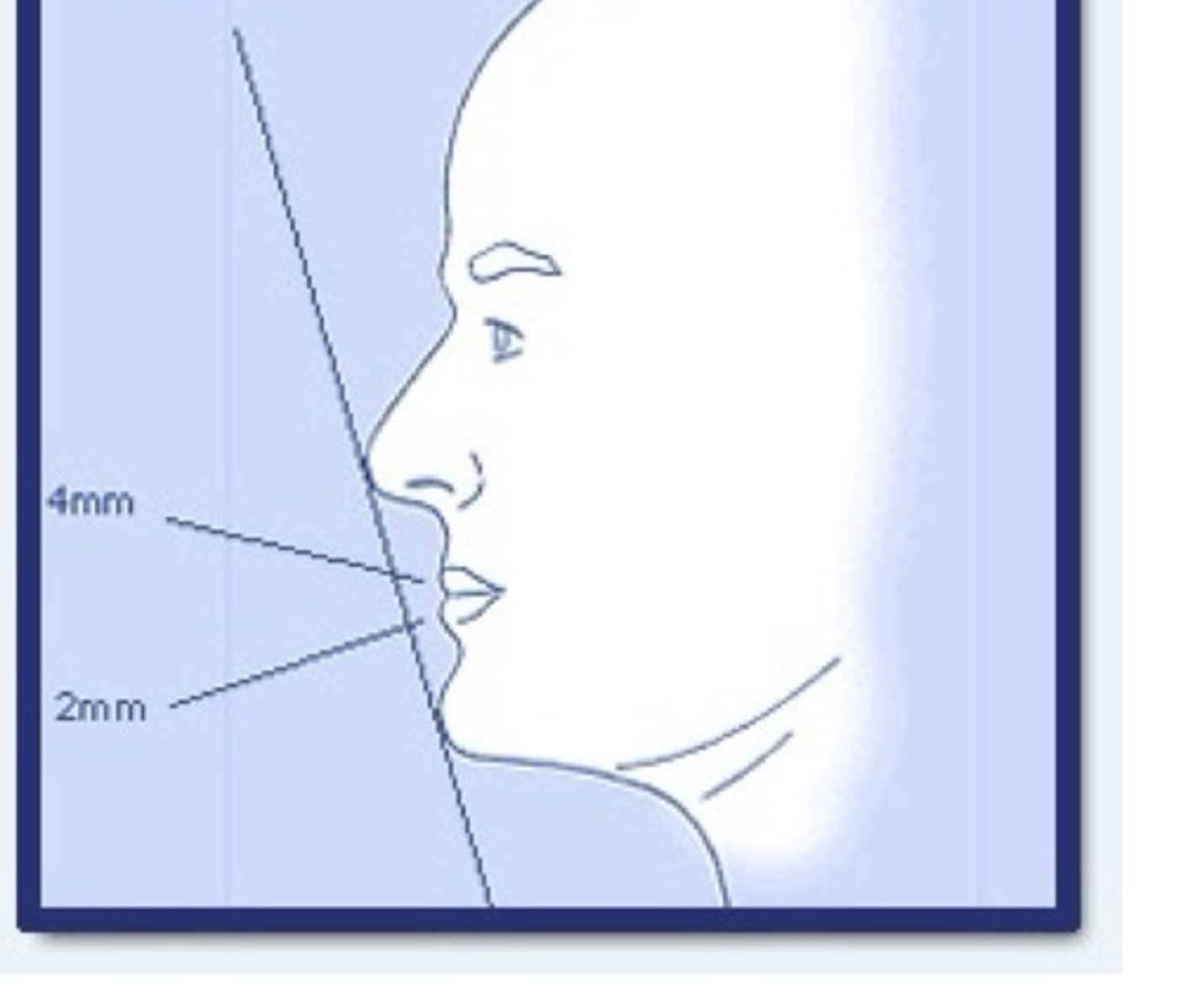 <p>This is described by Ricketts. Trace a line between the tip of the nose and the tip of the chin. In aesthetically ideal clients, the lips should be behind this plane, with the lower lip closer to it than the upper lip.</p>
