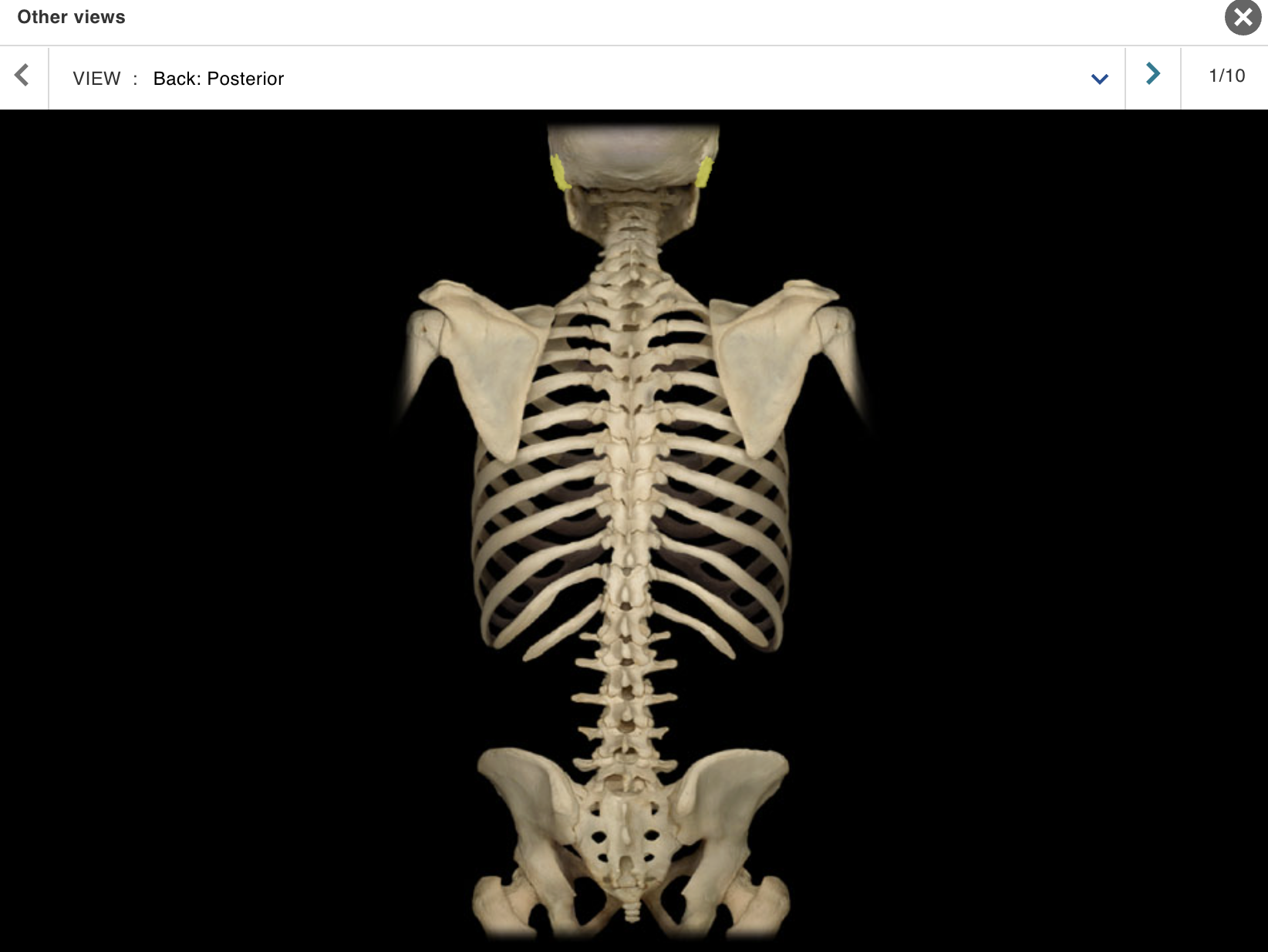 <p>Location:</p><p class="p1">• Skull (lateral and inferior)</p><p class="p1">Description:</p><ul><li><p>﻿﻿Paired, irregular-shaped, flat bone</p></li><li><p>﻿﻿Consists of squamous, petrous, mastoid, and tympanic parts</p></li></ul><p>Comment:</p><ul><li><p>﻿﻿Forms part of lateral skull (temple)</p></li><li><p>﻿﻿Forms inferior and lateral walls of middle cranial fossa</p></li><li><p>﻿﻿Articulates with sphenoid bone at sphenosquamosal suture, occipital bone at lambdoid suture, and parietal bone at squamosal suture</p></li><li><p>﻿﻿Has mandibular fossa that forms temporomandibular joint with head of mandible</p></li><li><p>﻿﻿Forms zygomatic process that forms zygomatic arch with temporal process of zygomatic bone</p></li></ul><p></p>