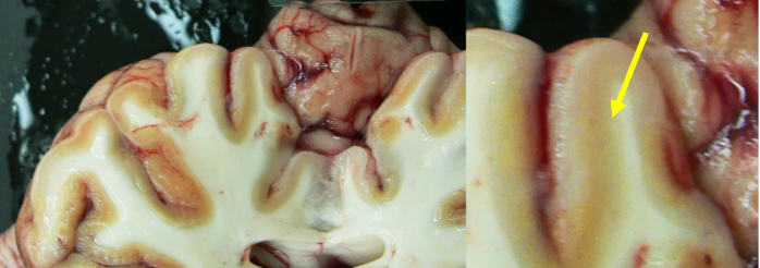 <p>laminar cortical necrosis </p>