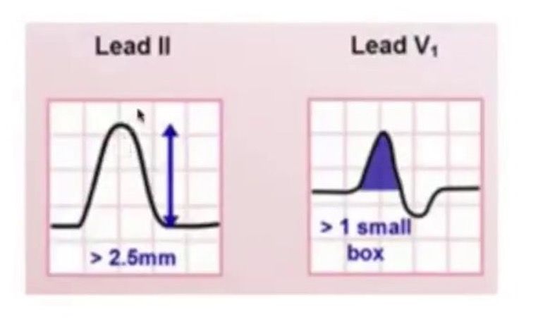 <p>upright P wave taller than 2.5 mm in limb leads</p><p>biphasic P wave w/ lager pos initial deflection and neg smaller terminal deflection in V1</p>