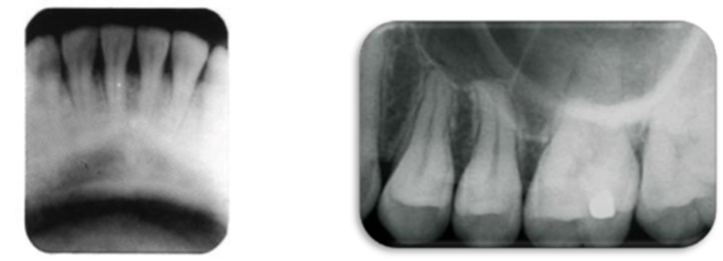 <p>This photo was taken with the bisecting angle technique. What went wrong?</p>