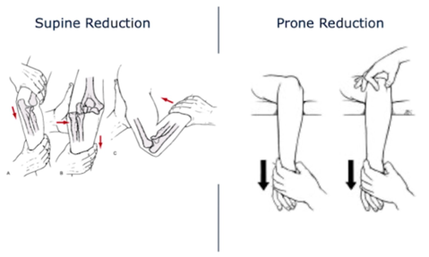 <p>Closed reduction (either supine or prone) and stability check ROM ASAP</p><p>If complicated → surgery</p>