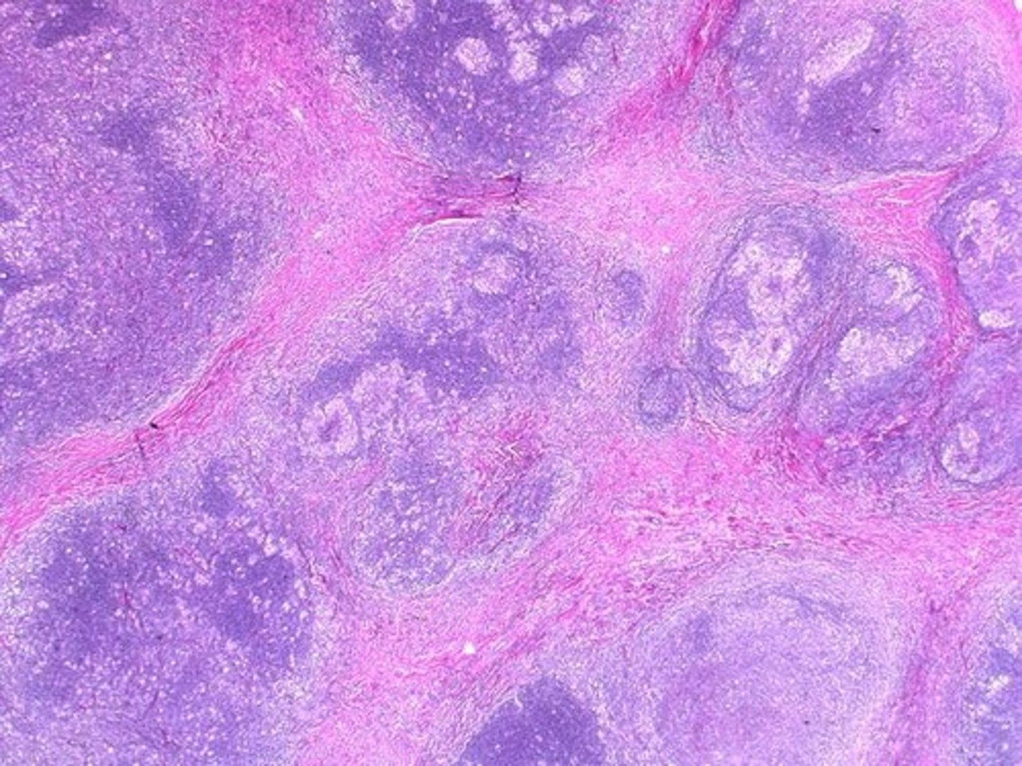 <p>Indolent lymphoma with generalized lymphadenopathy.</p>