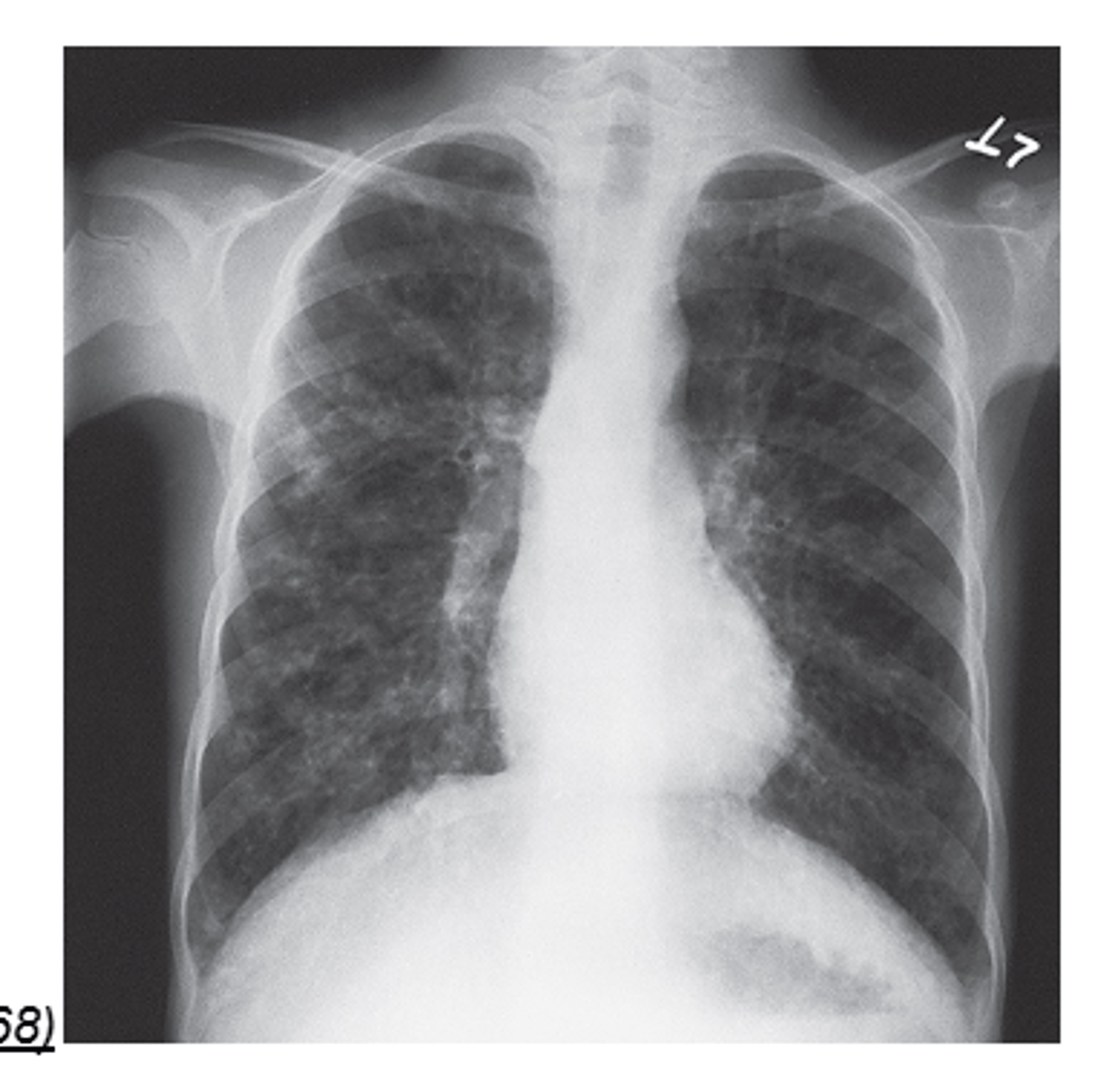 <p>A disorder resulting from a genetic defect transmitted as an autosomal recessive gene that affects the function of exocrine glands</p>