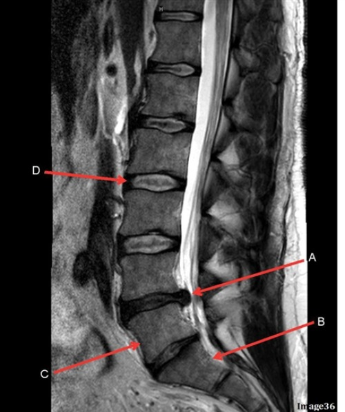 <p>Letter B in Image 36 is pointing to:</p><p>A. Body of L1</p><p>B. Body of L3</p><p>C. Body of L5</p><p>D. Body of S1</p>