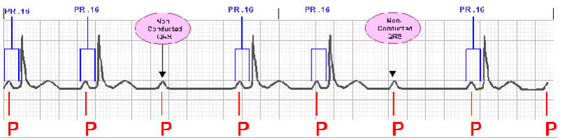 <p>What type of heart block is shown? </p>