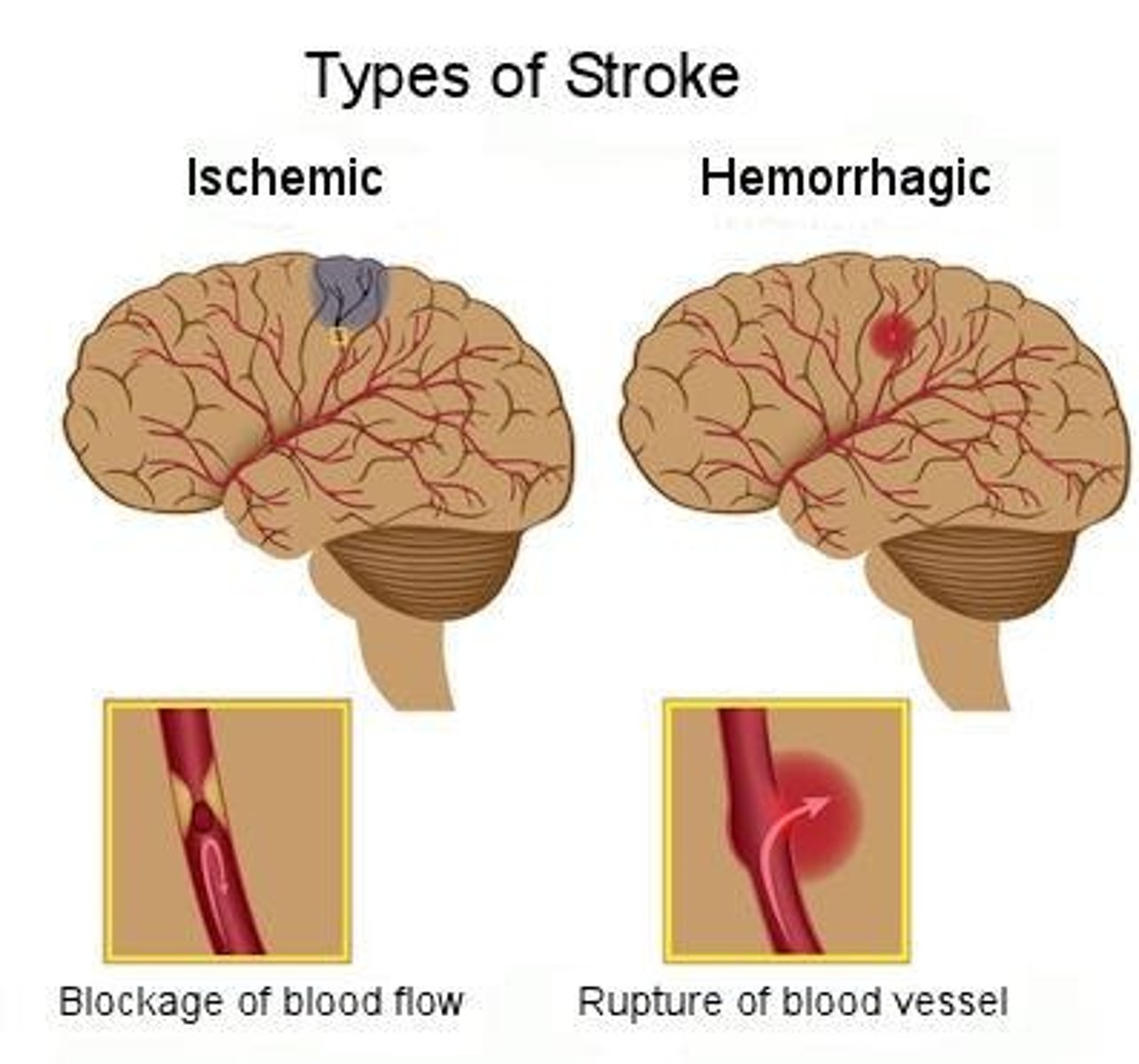 <p>Condition of excess CSF causing increased ICP.</p>