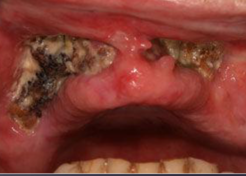 <p>occurs 4m to 3yrs after radiotherapy </p>