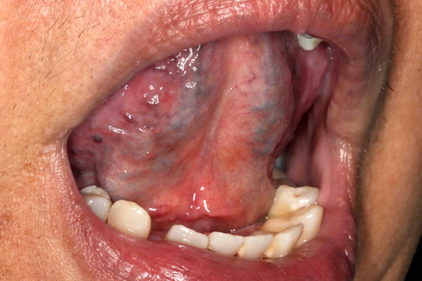 <p>A patient presents with blue-purple on the ventral lesion on the ventral tongue that blanches when pressure is applied.</p><p>What is the most likely diagnosis?</p>