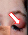 <p>what is dacryoadenitis?</p>