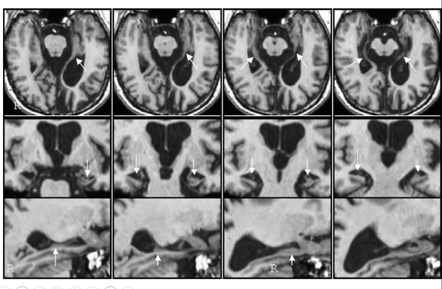 <p>anterograde amnesia with retrograde amnesia is most likely lesion in _______ and sonicated structures in medial temporal lobe          </p>