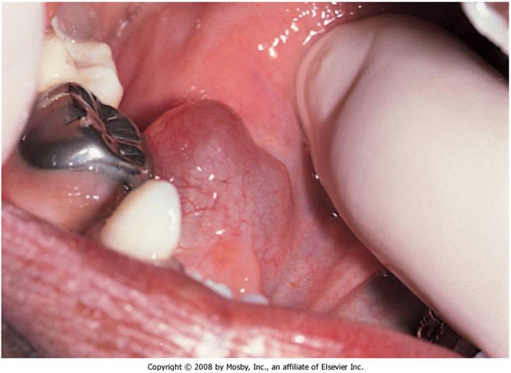 <p>fluid collection or cyst under the tongue </p>